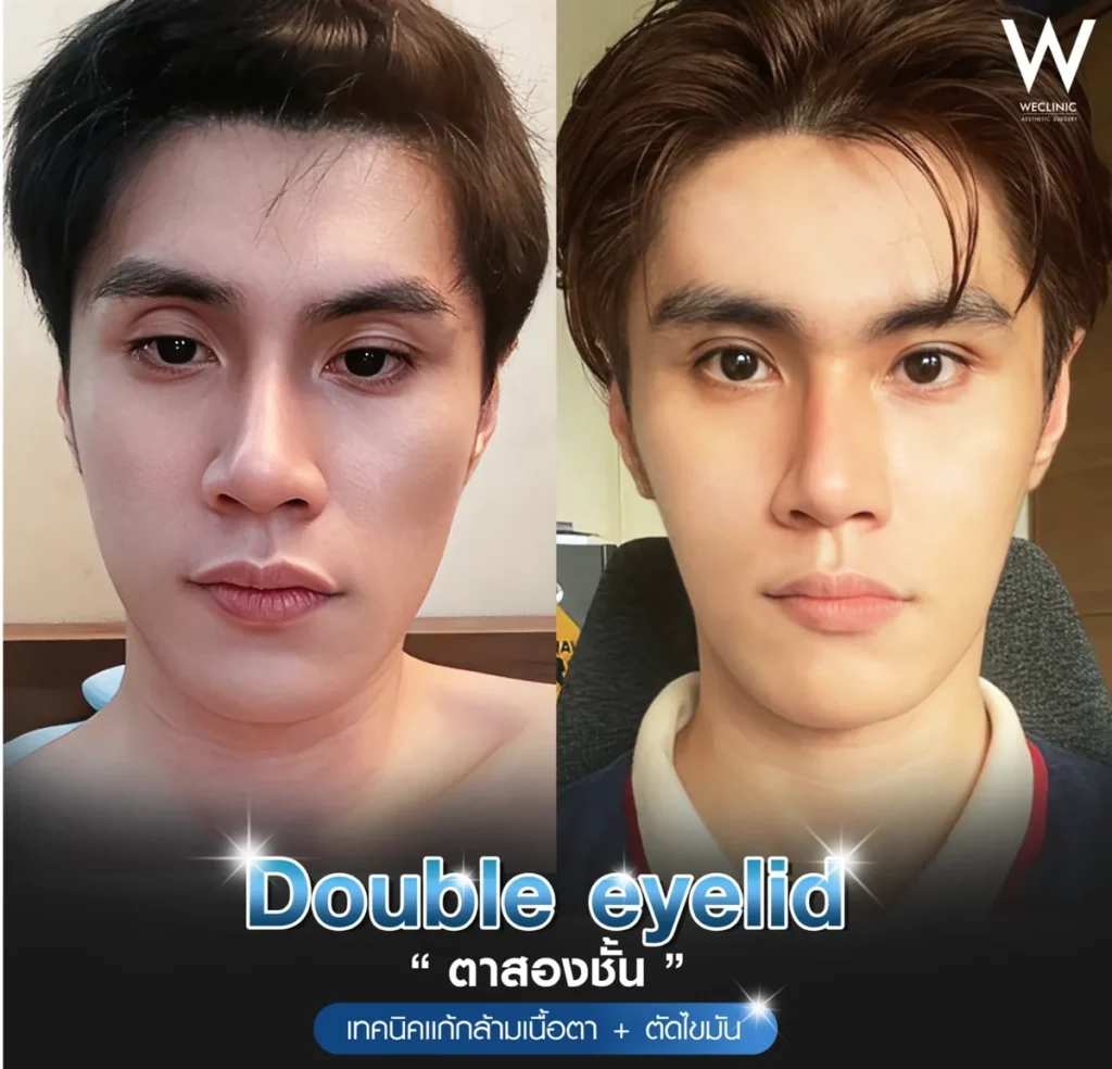 double-eyelid-ptosis-correction-men-before-after-01