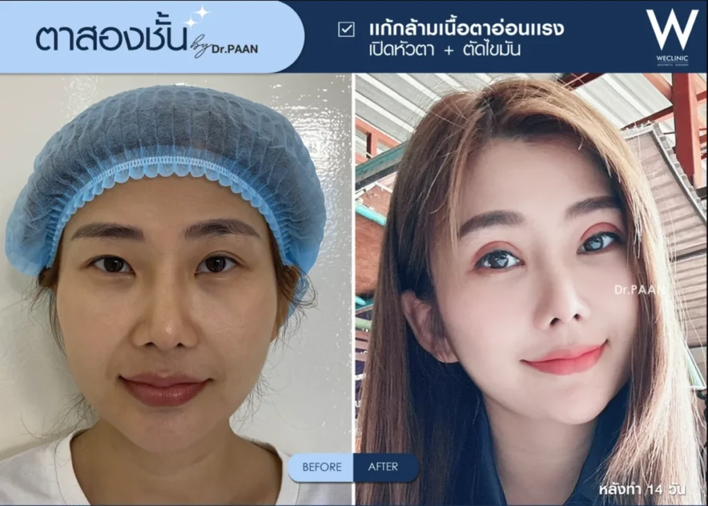 double-eyelid-ptosis-epicanthoplasty-before-after-02