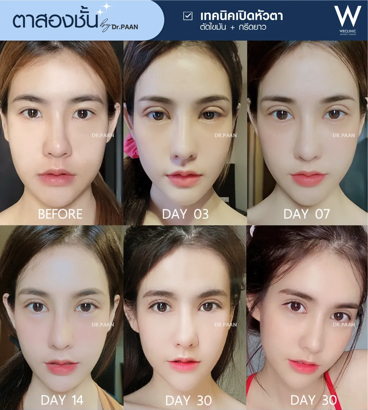 double-eyelid-recovery-timeline-day3-to-day30