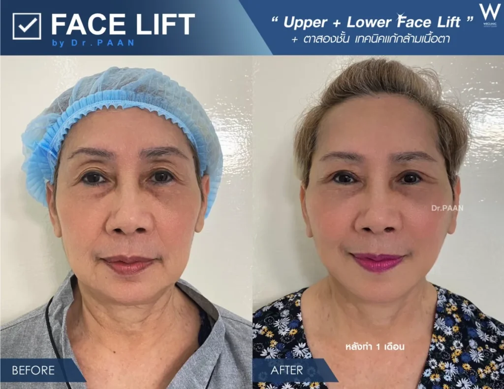 facelift-upper-lower-double-eyelid-before-after-front