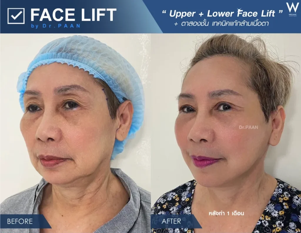facelift-upper-lower-double-eyelid-before-after-side