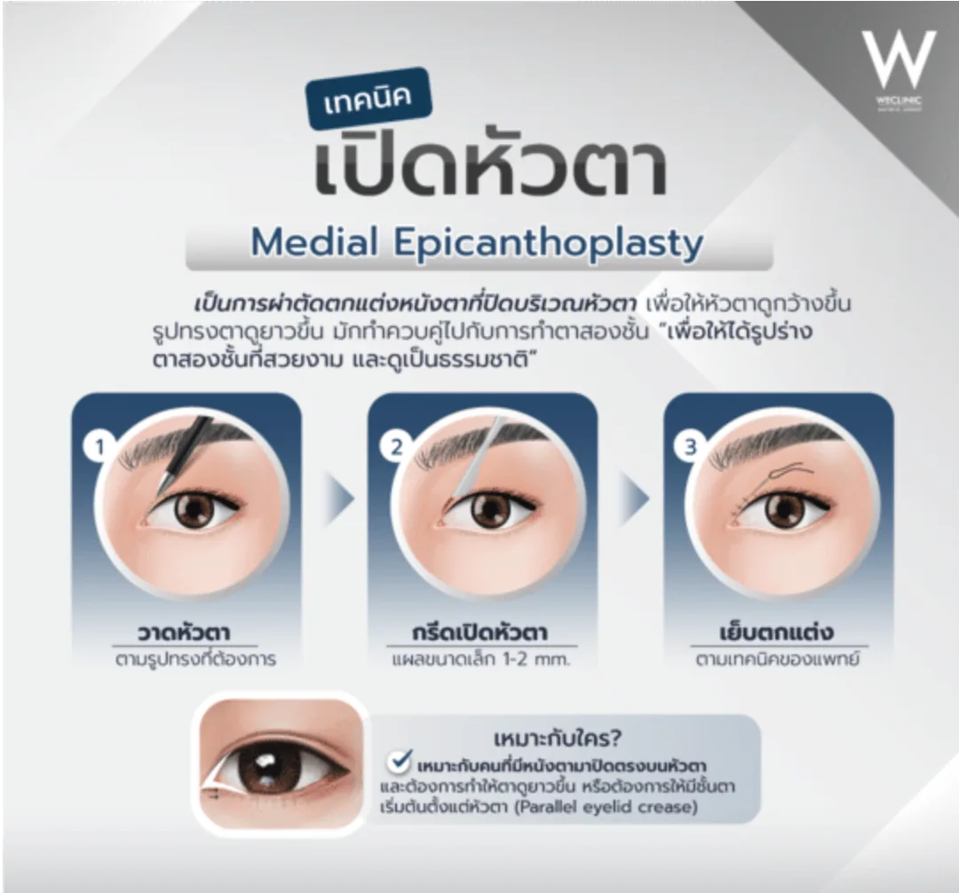medial-epicanthoplasty-technique