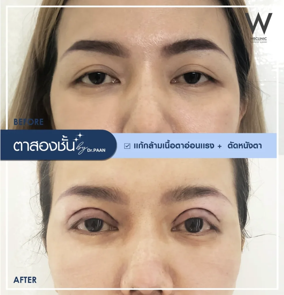 ptosis-correction-before-after-01