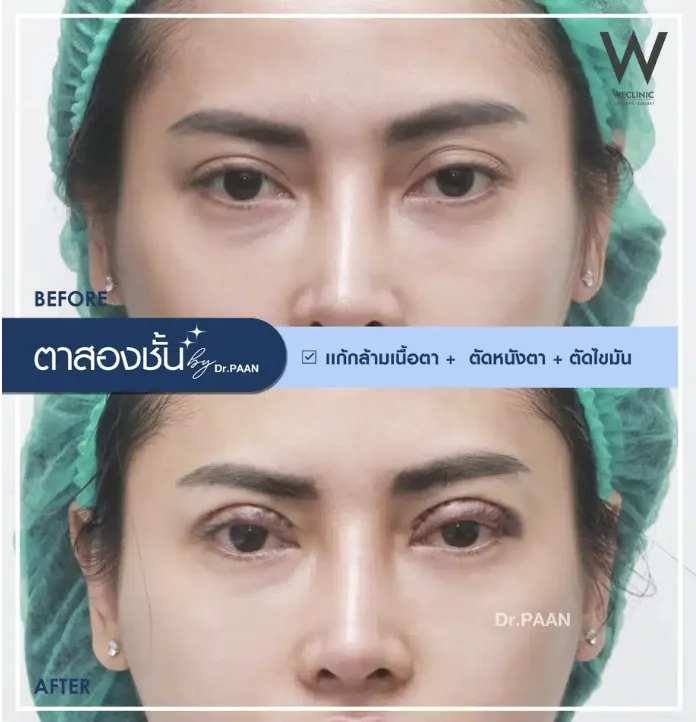 ptosis-correction-before-after-02