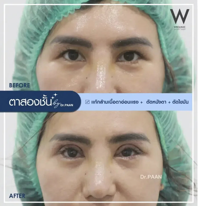 ptosis-correction-before-after-03