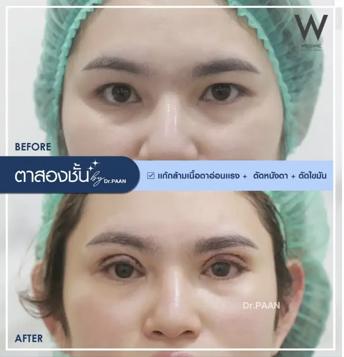 ptosis-correction-before-after-04
