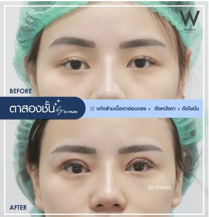 ptosis-correction-before-after-05