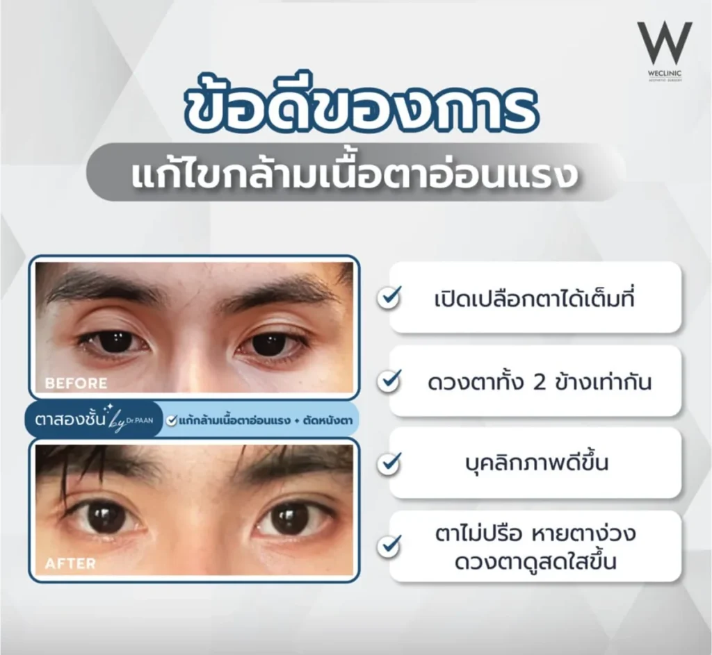 ptosis-correction-benefits
