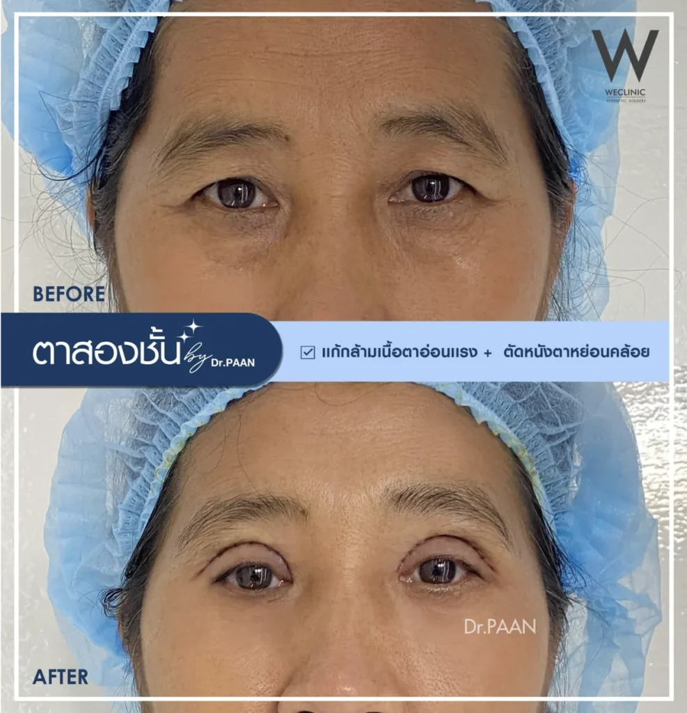ptosis-correction-droopy-eyelid-senior-before-after