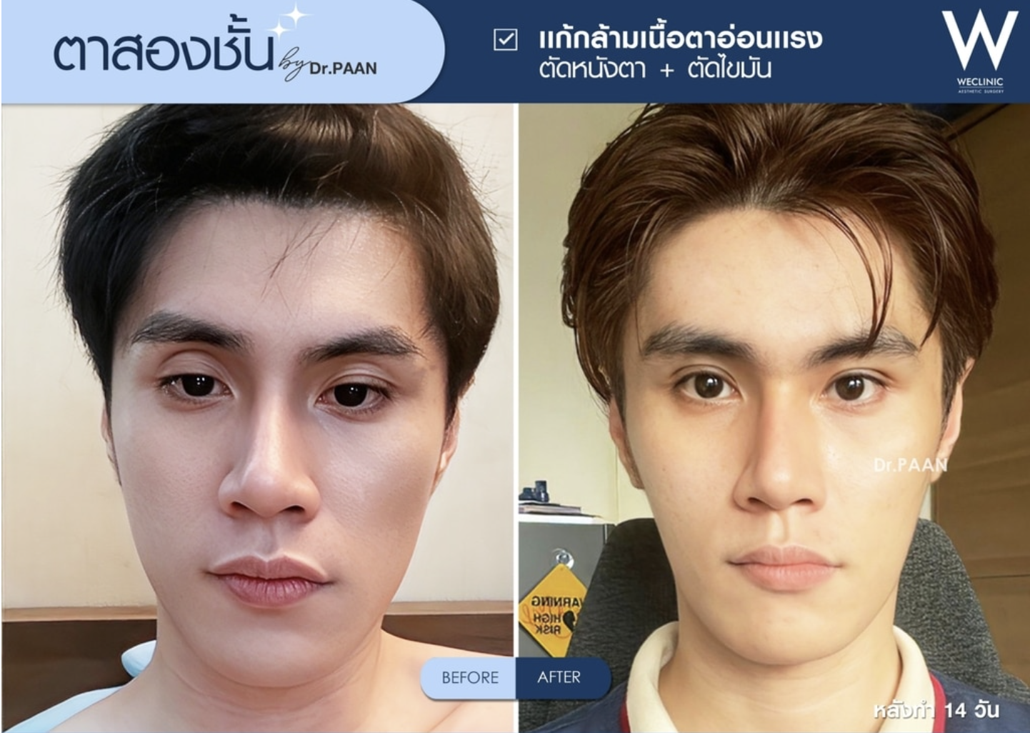 ptosis-correction-men-before-after-01