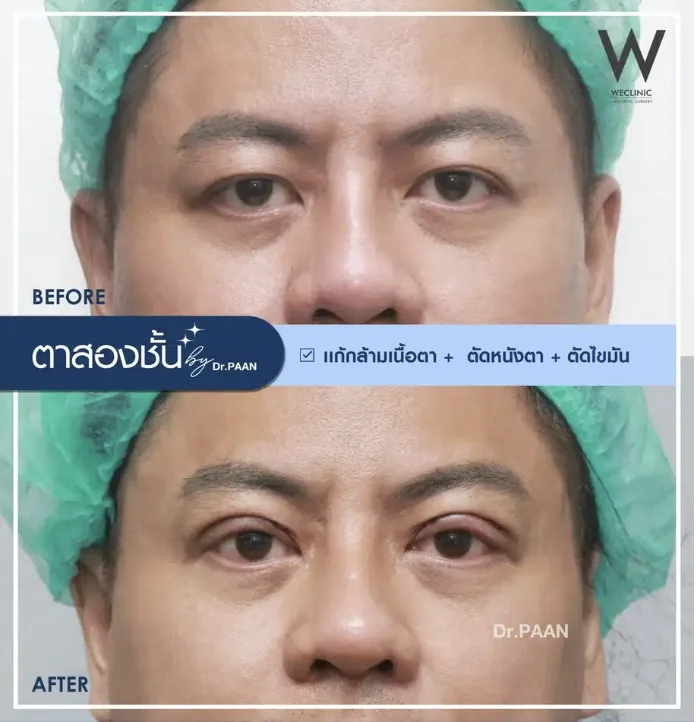 ptosis-correction-men-before-after-02