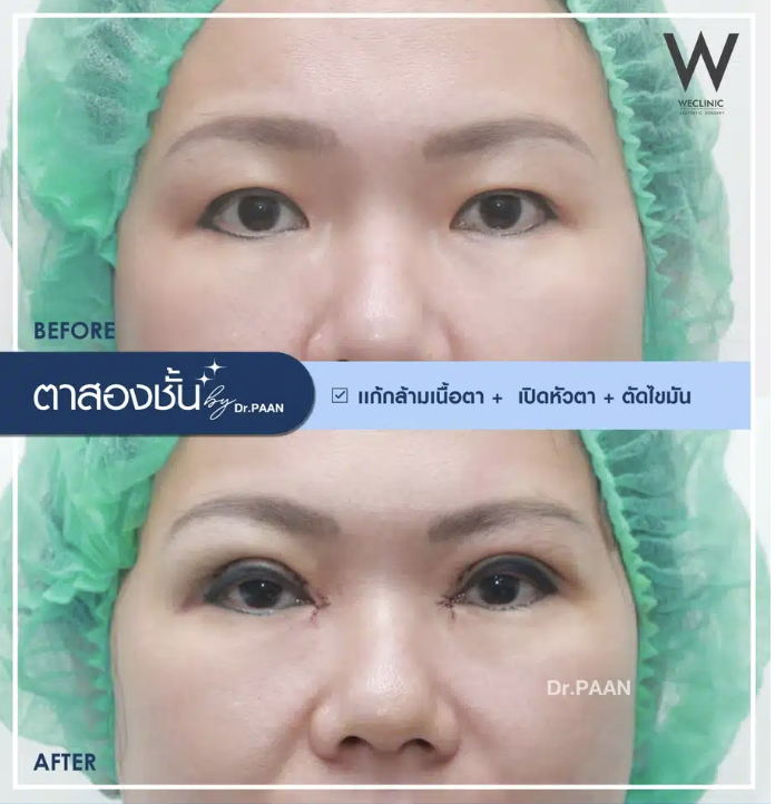 ptosis-epicanthoplasty-before-after