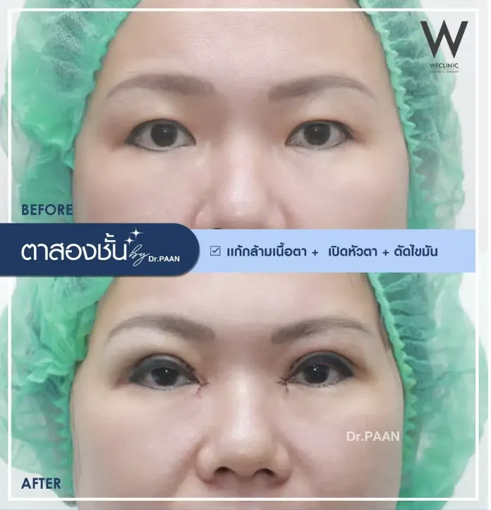 ptosis-epicanthoplasty-before-after