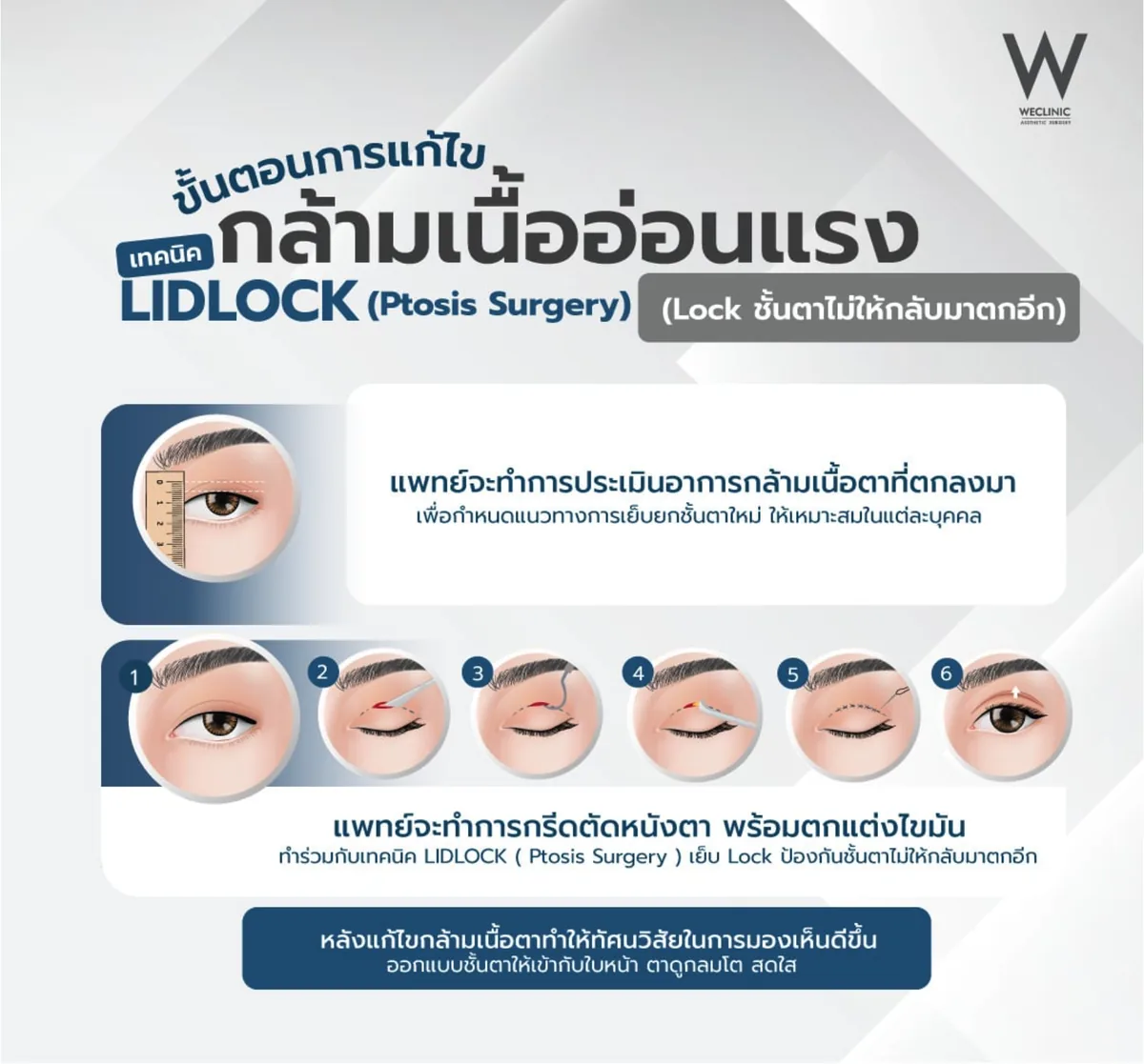 ptosis-surgery-lidlock-technique-steps-01