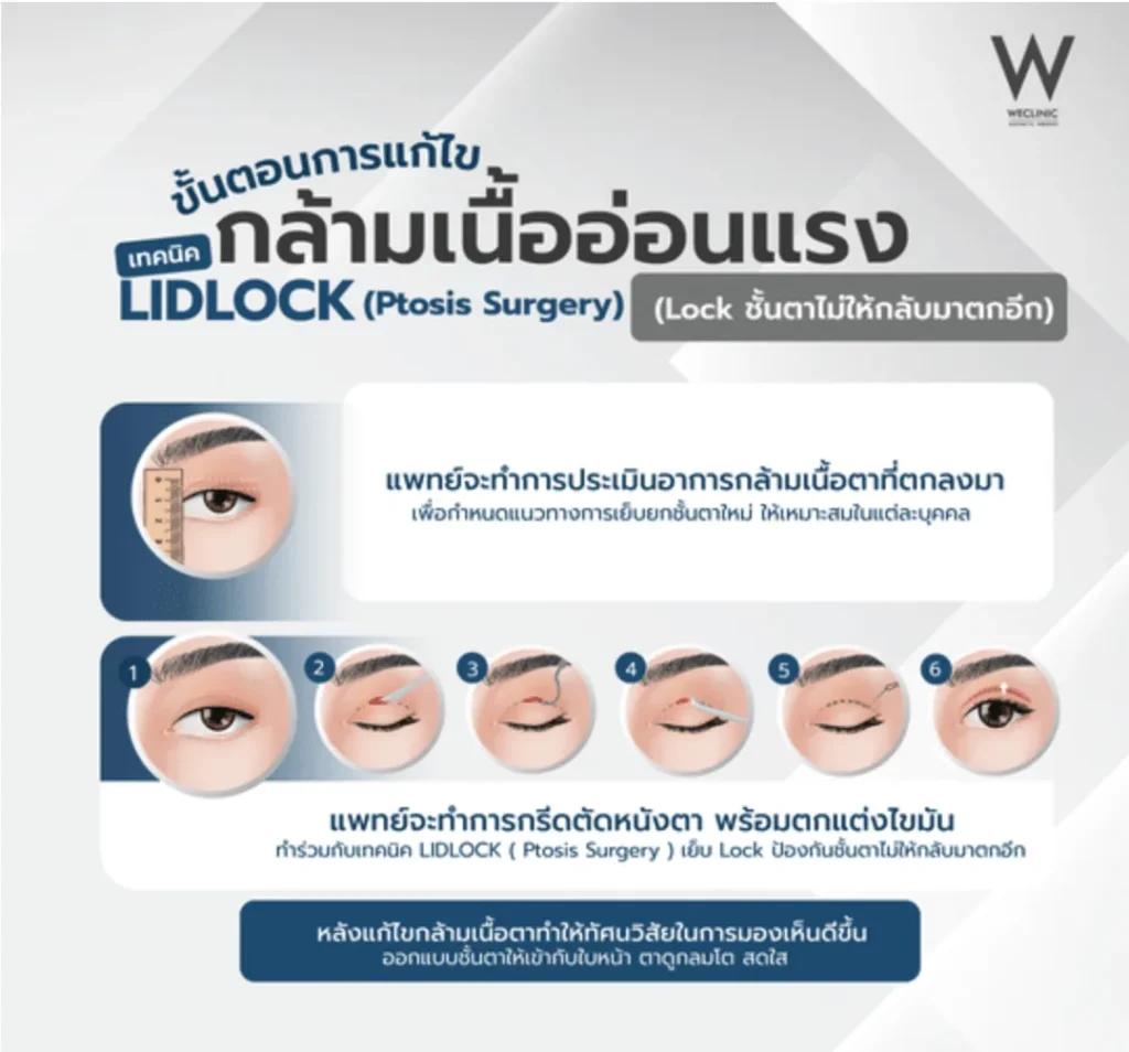 ptosis-surgery-lidlock-technique-steps-02