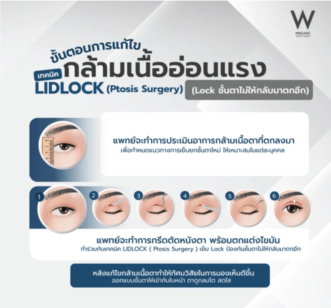 ptosis-surgery-lidlock-technique-steps-02