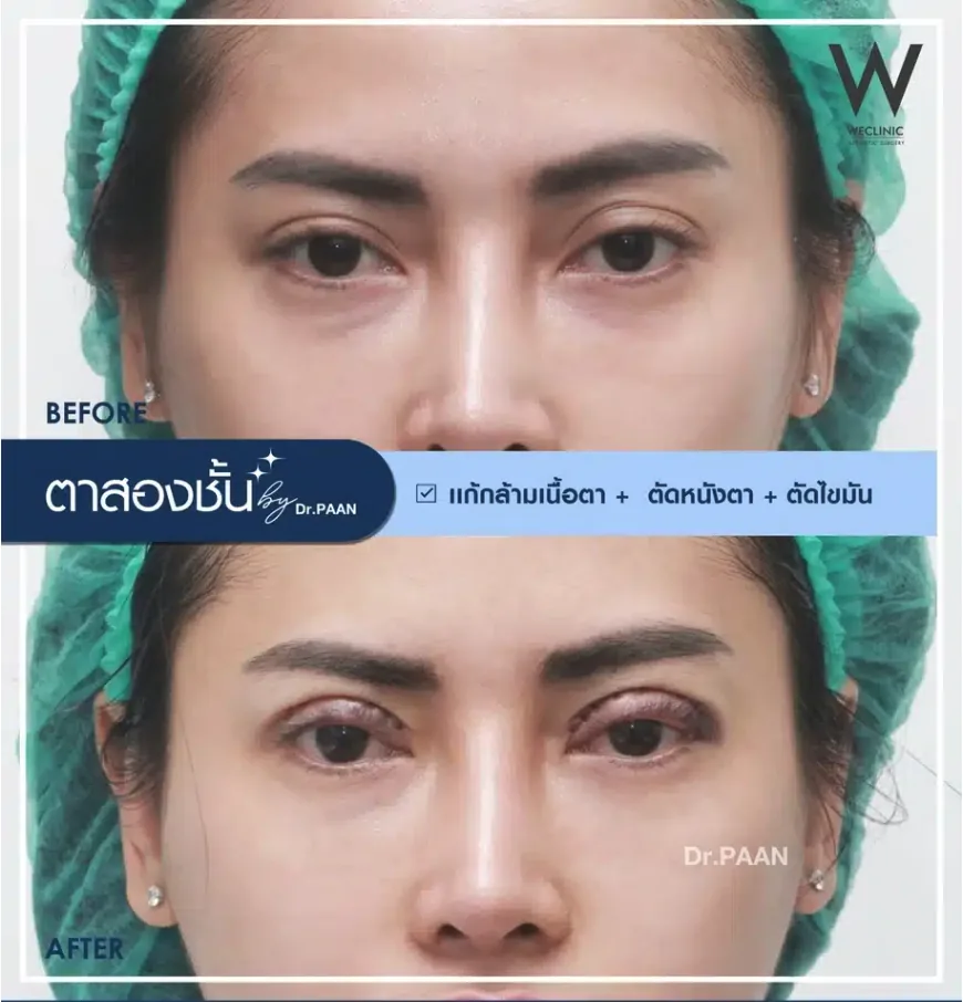 sunken-eye-correction-fat-transfer-technique-01