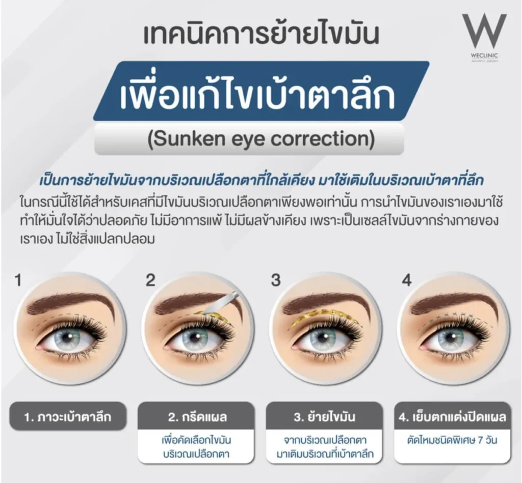 sunken-eye-correction-fat-transfer-technique-02