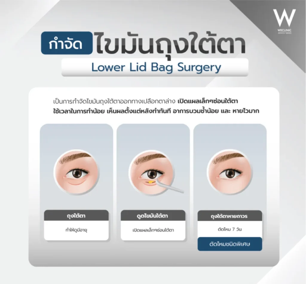 under-eye-bag-fat-removal-technique