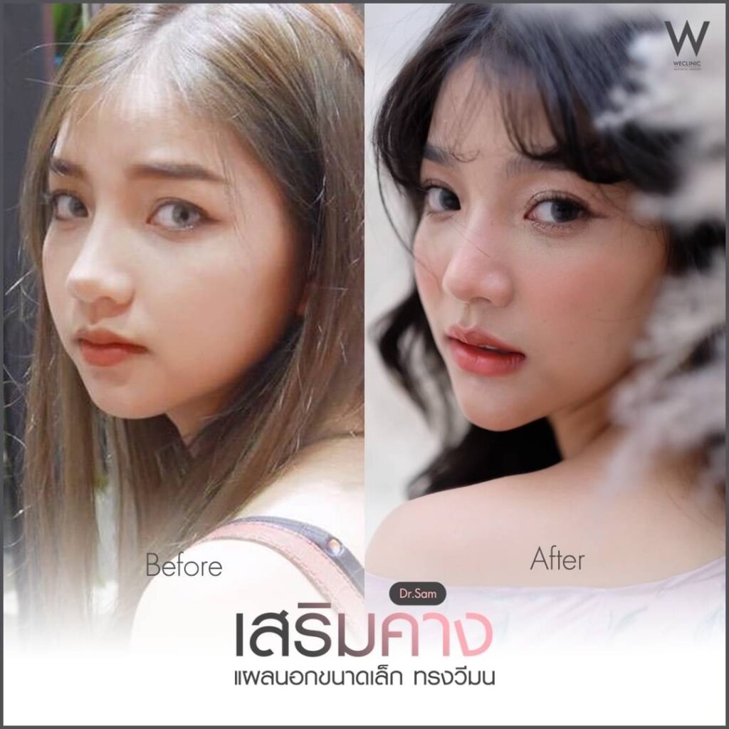 คางสั้น คืออะไร