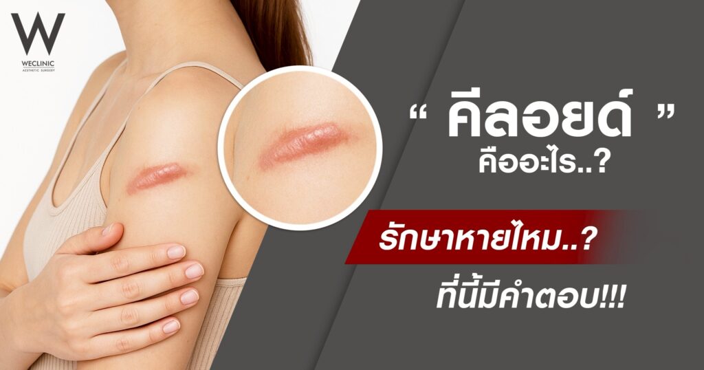 คีลอยด์ คืออะไร รักษาหายไหม