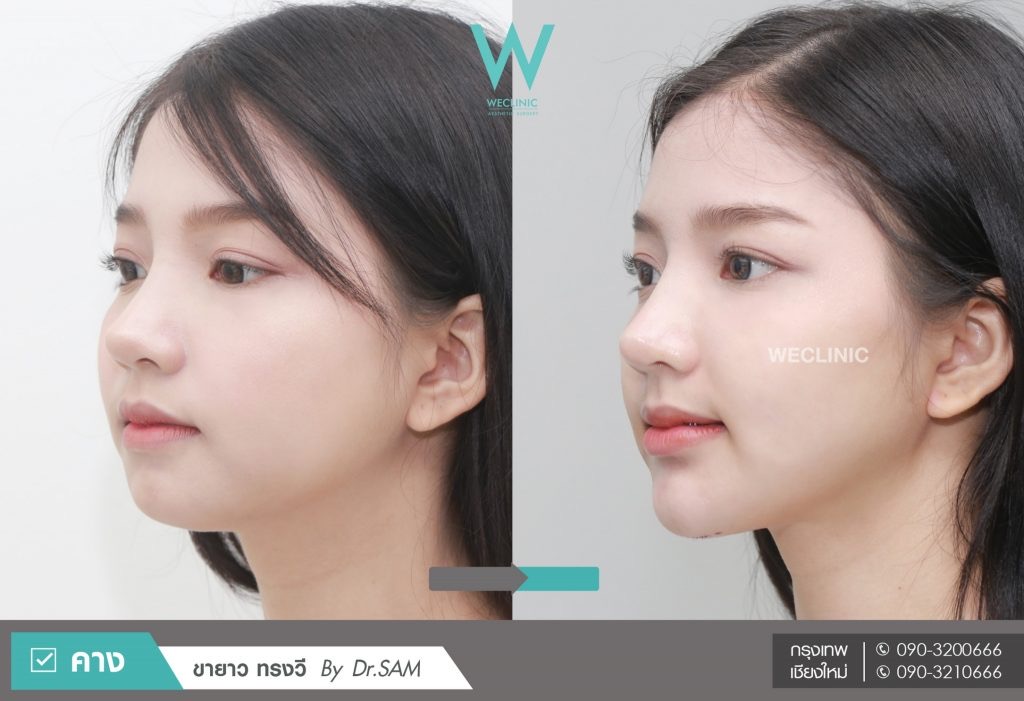 วิธีเช็กว่าคางของเราสั้นหรือไม่