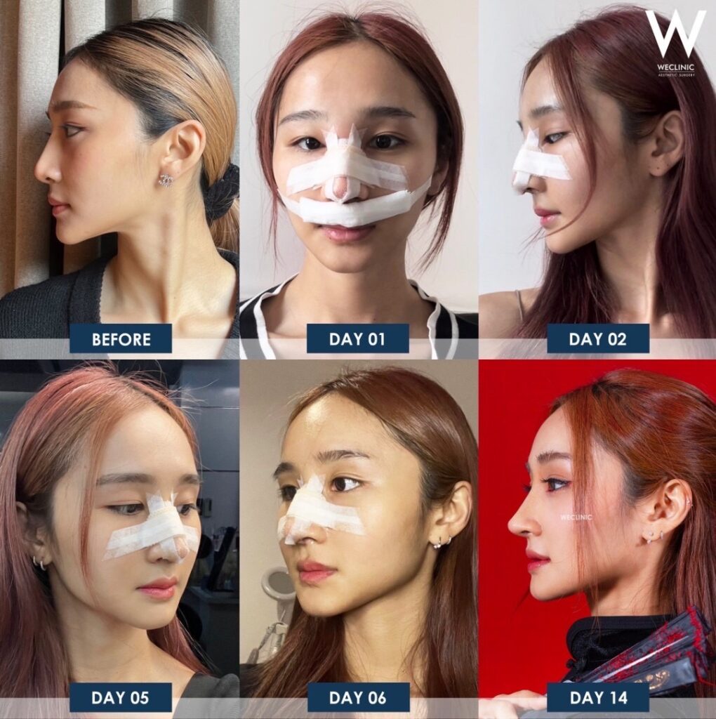 หลังเสริมจมูก 14 วัน