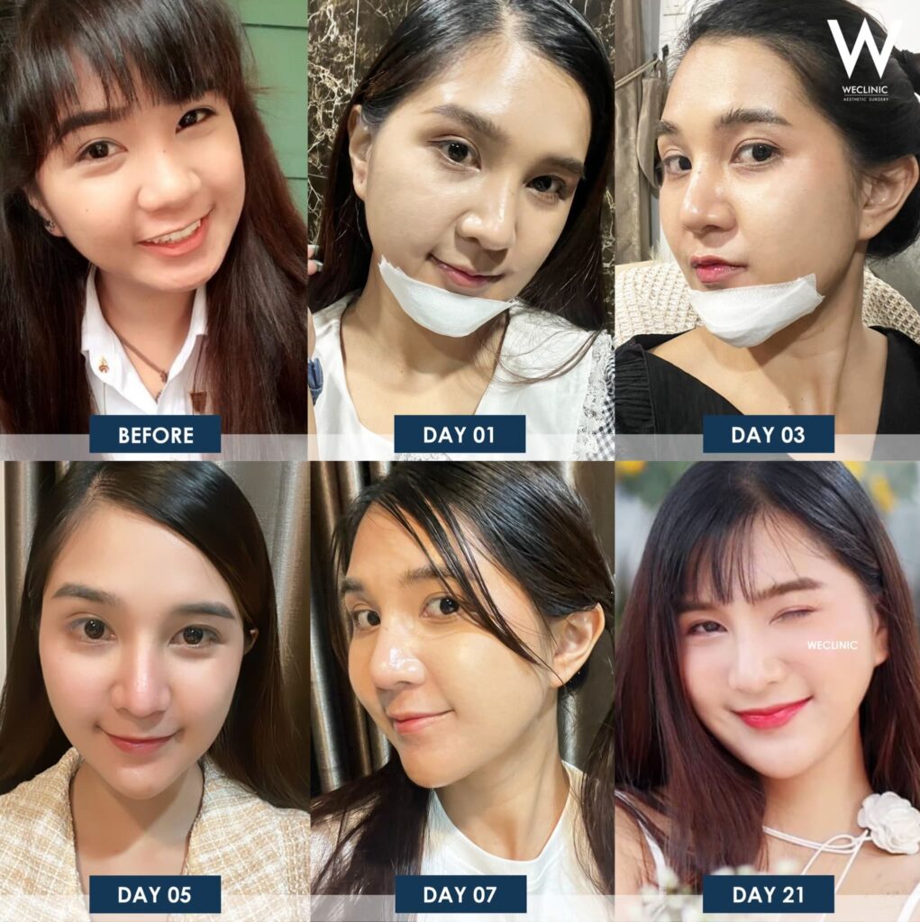 รีวิวศัลยกรรม 21 วัน