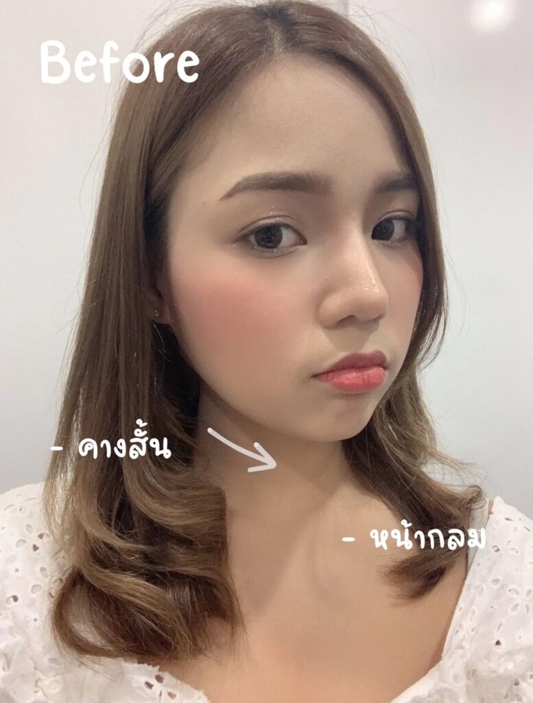รีวิวหลังเสริมคาง คางสั้น หน้ากลม