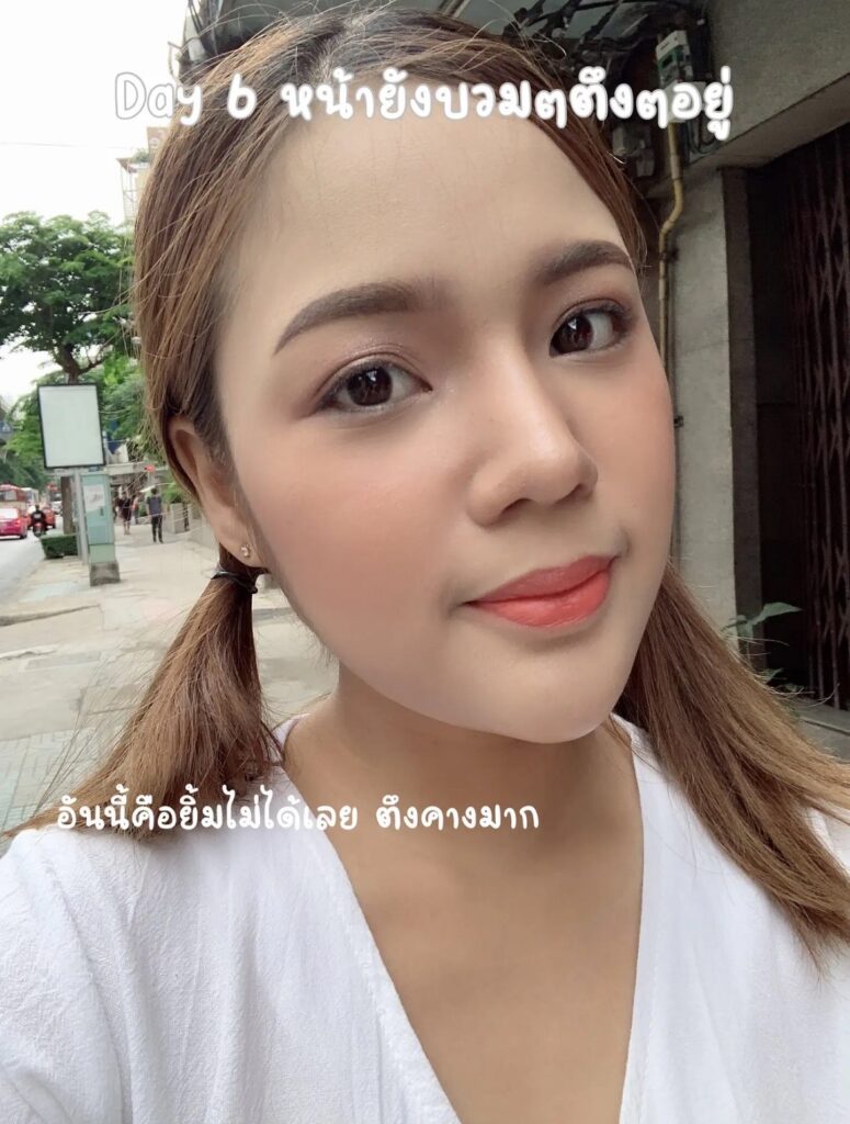 หลังศัลยกรรมคางหน้าบวม