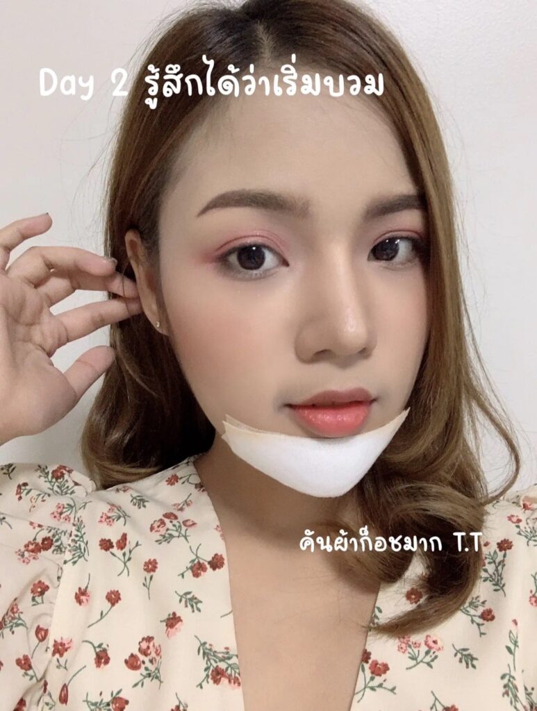 หลังเสริมคางกินอาหารแสลงจะเริ่มบวม