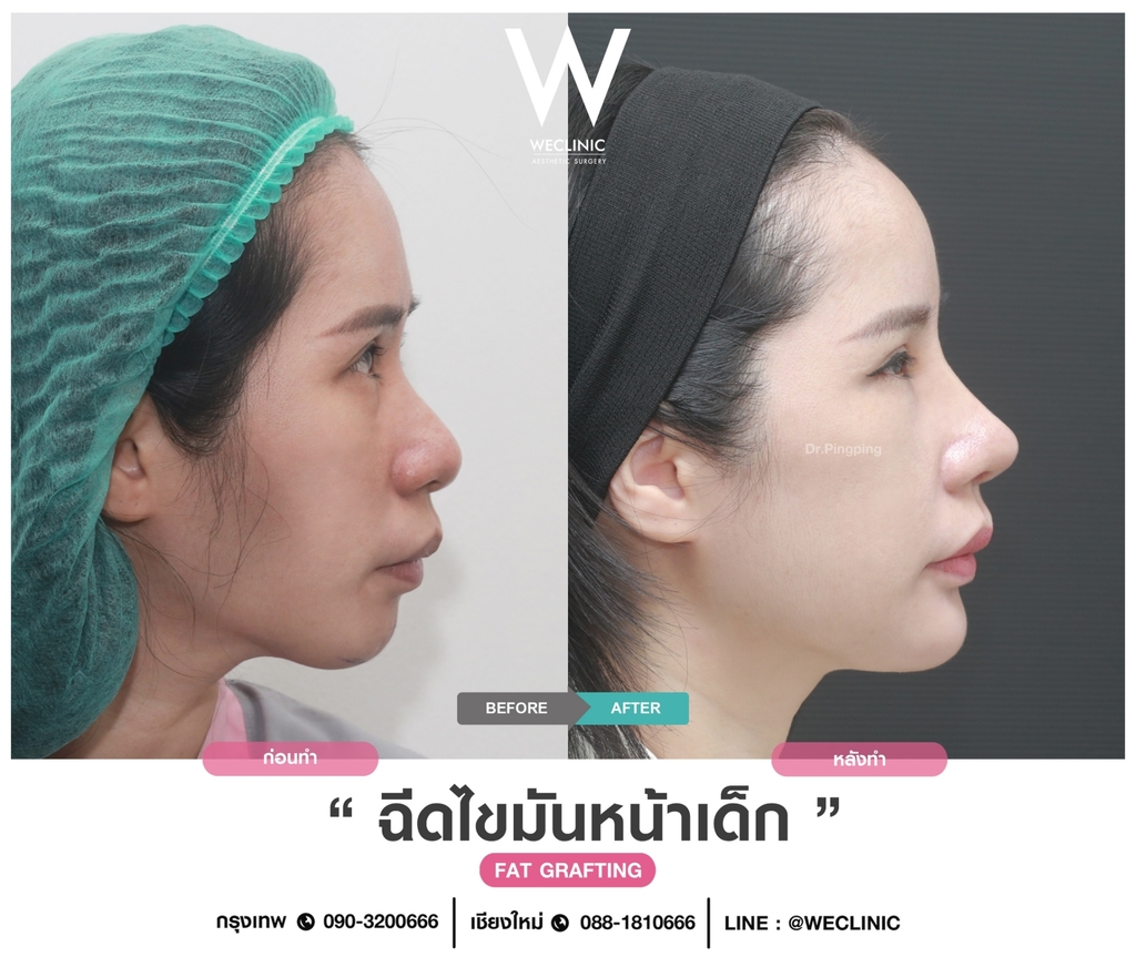 รีวิวฉีดไขมันหน้าเด็ก