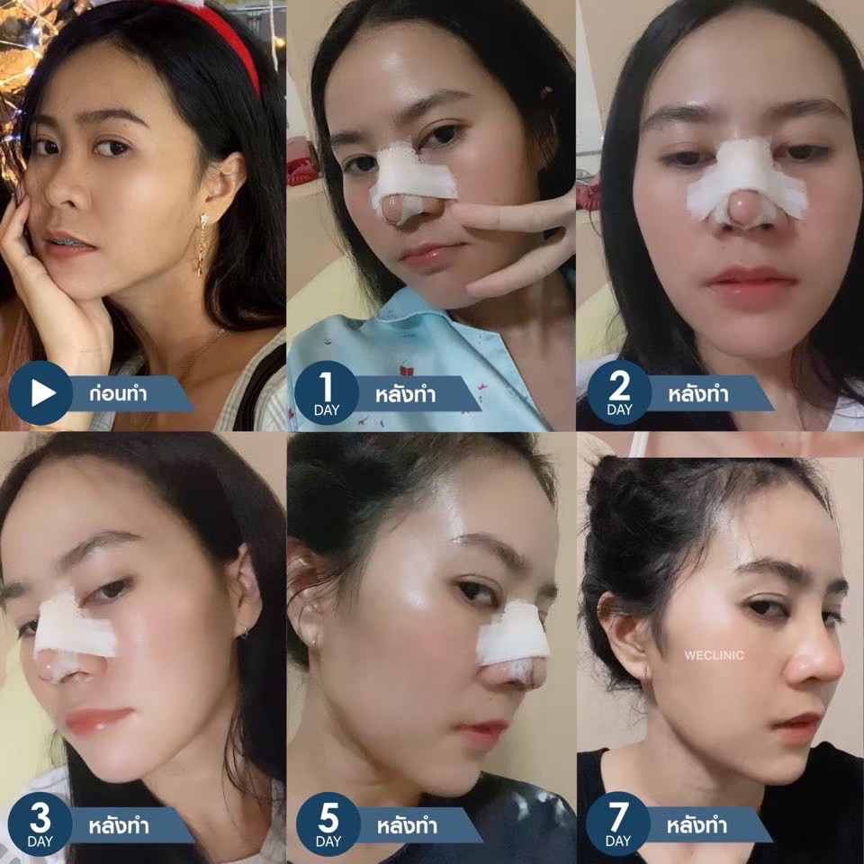 หลังเสริมจมูก 14 วัน