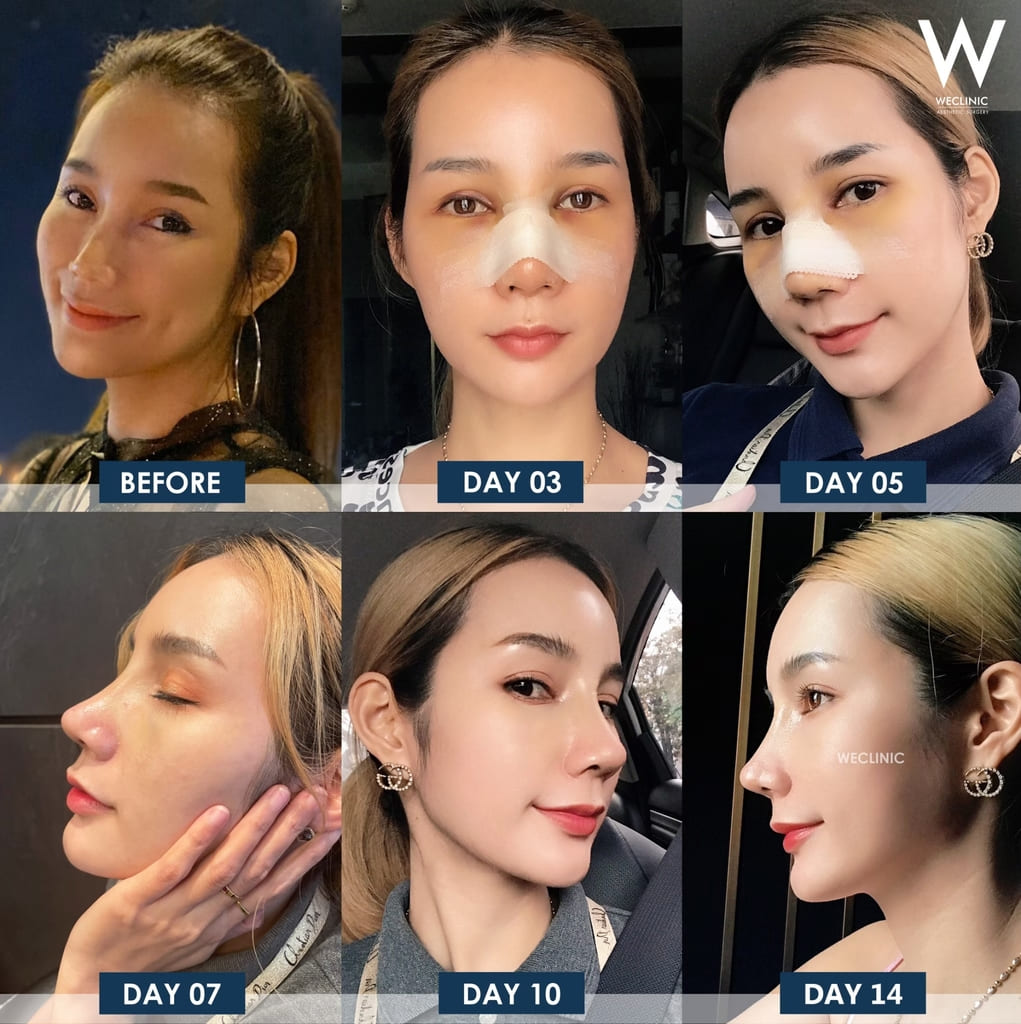 หลังเสริมจมูก 14 เข้าที่แล้วหรือยัง