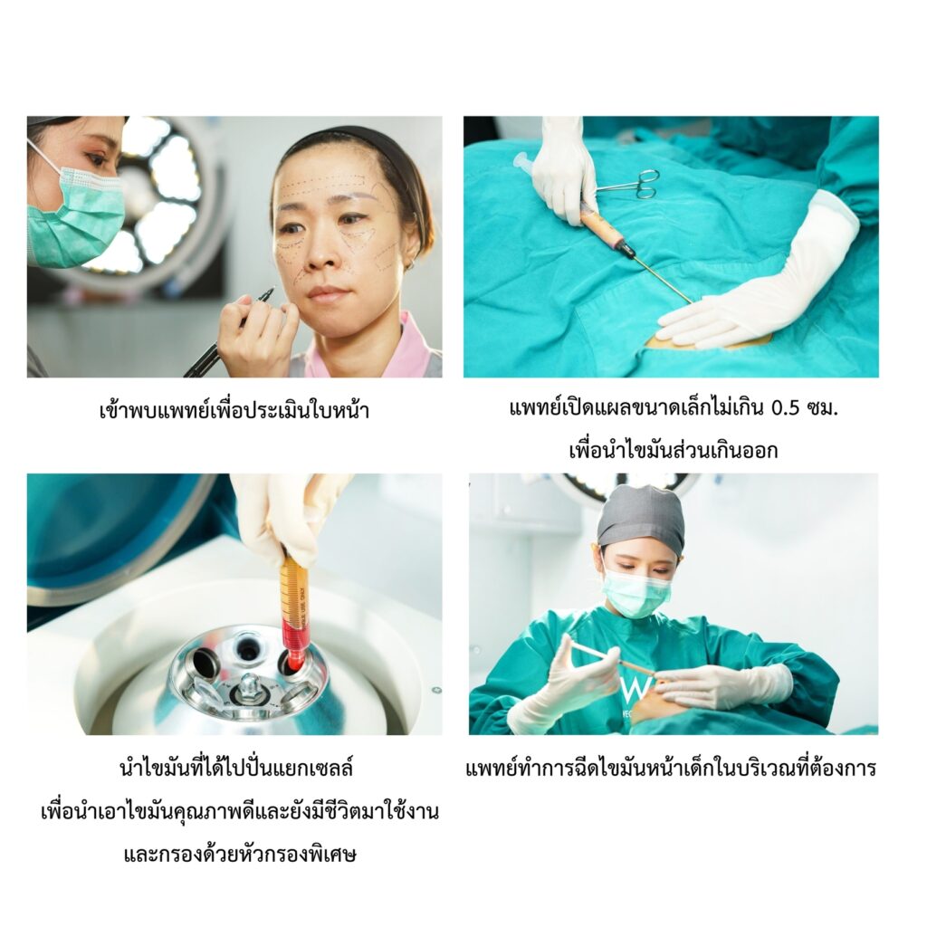 เติมไขมันทำให้หน้าเด็กได้อย่างไร