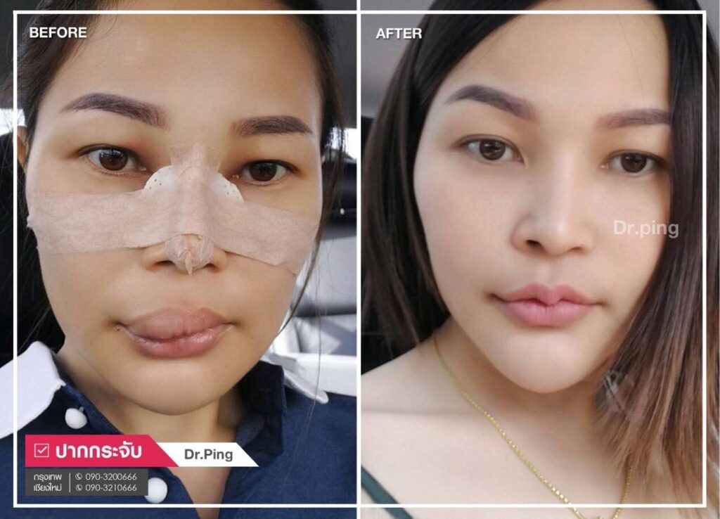 ปากไม่เท่ากัน คืออะไร