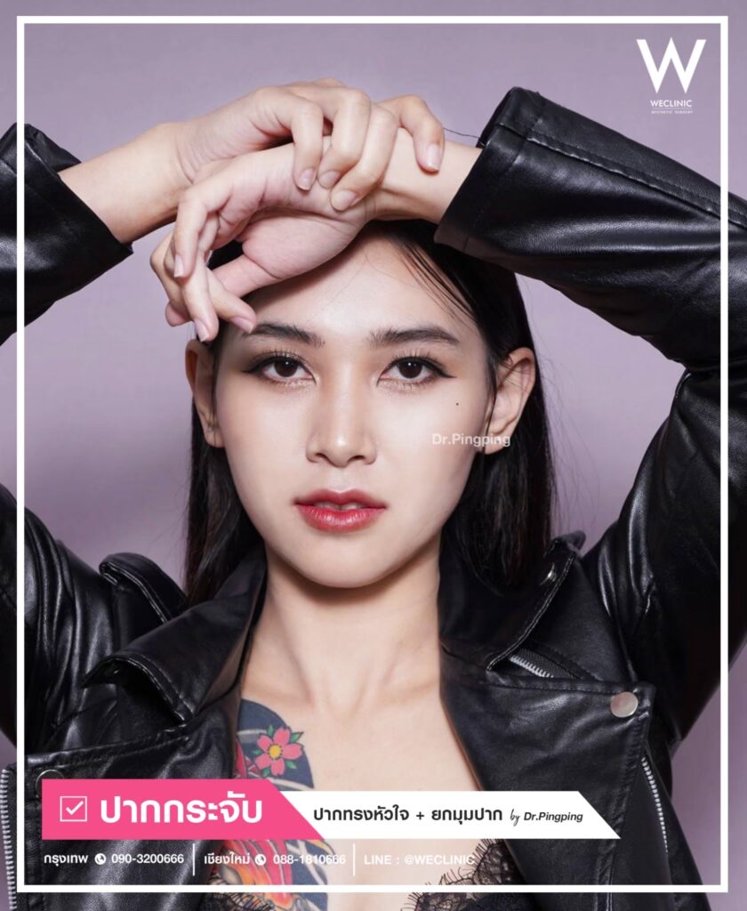 ผ่าตัดปากกระจับแก้ปากไม่เท่ากัน