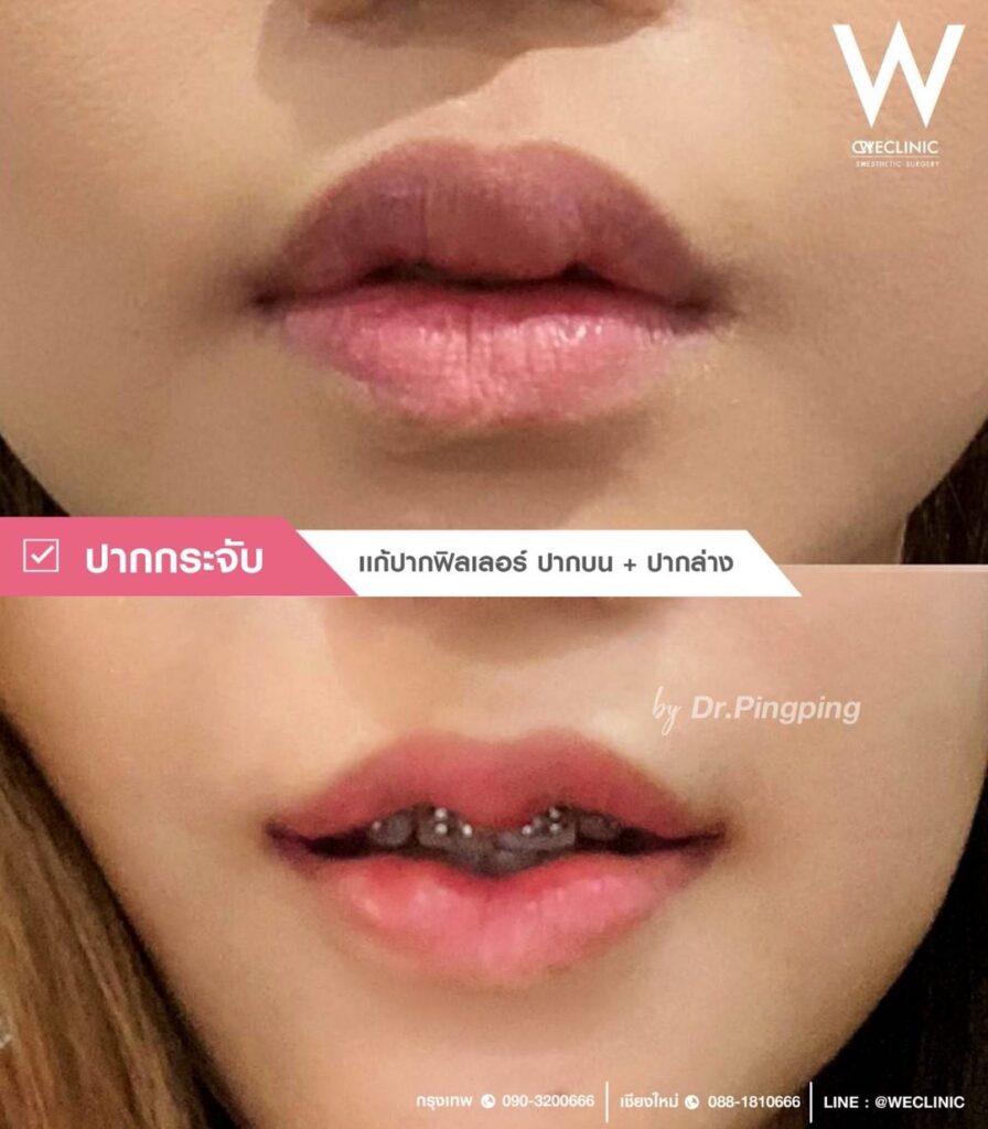 สาเหตุปากไม่เท่ากัน