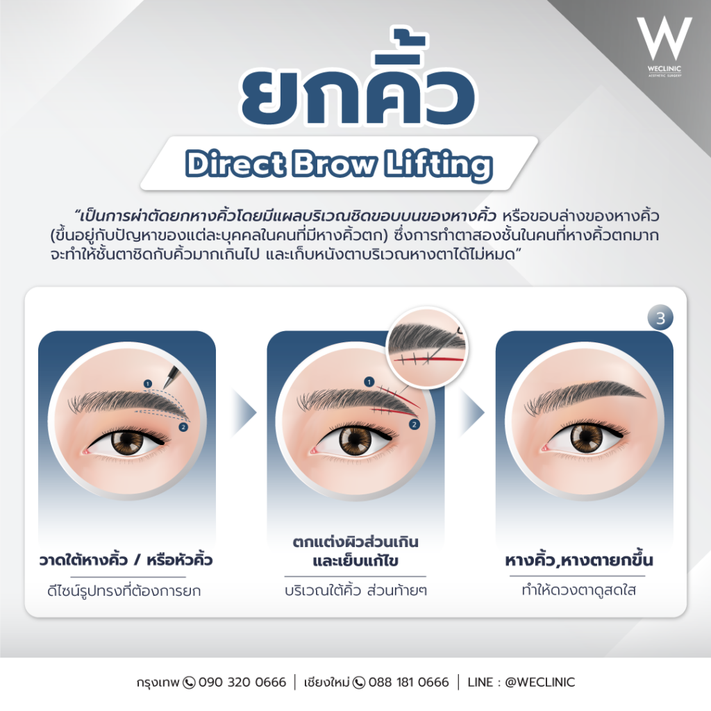 ยกคิ้ว Direct Brow Lifting