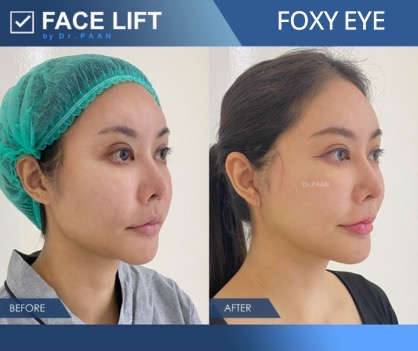 รีวิวทำ foxy eyes ด้วยการยกกระชับหน้า