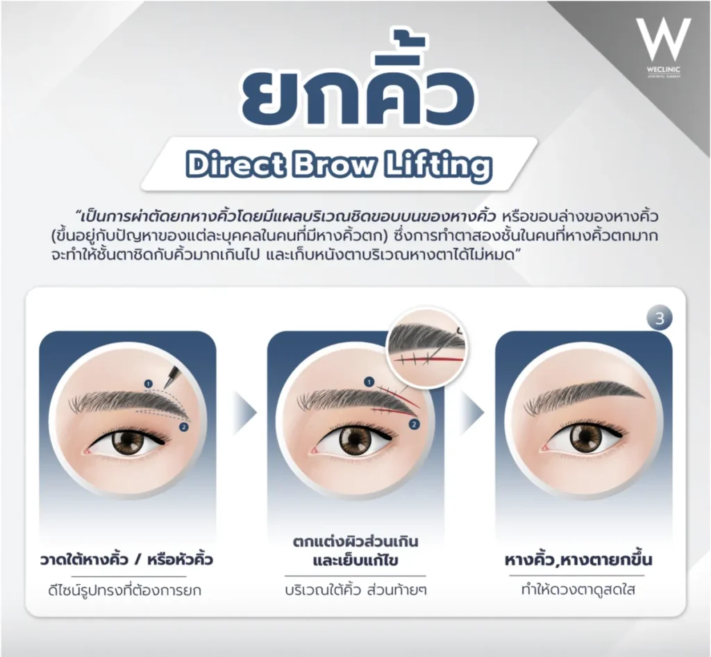 foxy-eyes-direct-brow-lifting-procedure-steps