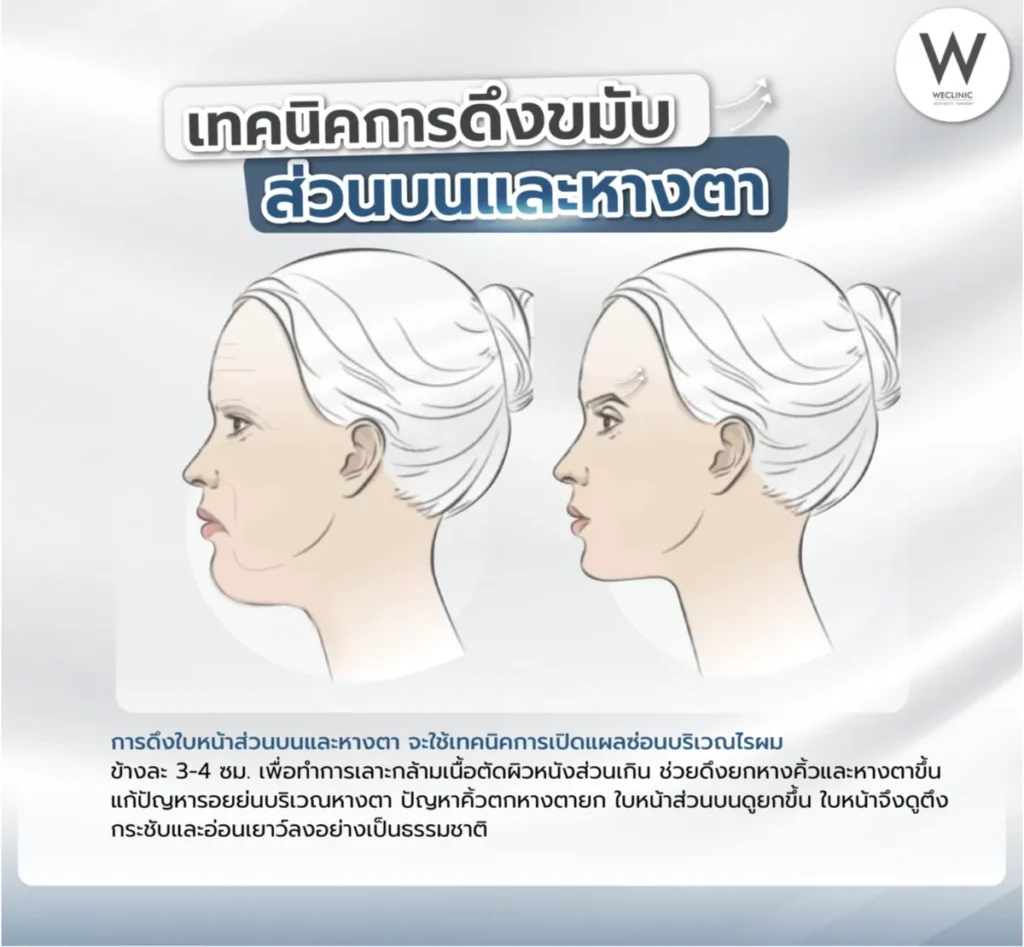 foxy-eyes-temporal-lift-before-after