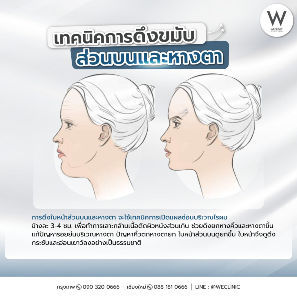 การดึงขมับส่วนบนและหางตา