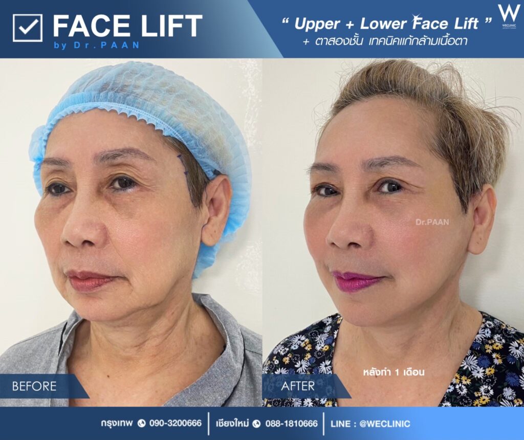 ผ่าตัดแก้หนังตาตก ราคาเท่าไร