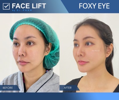 รีวิวทำ foxy eyes ด้วยการยกกระชับหน้าก่อนและหลังทำ