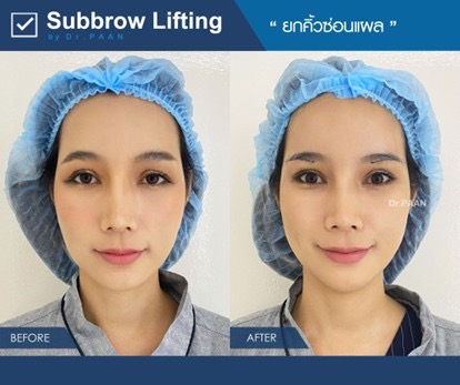 รีวิวทำ foxy eyes ด้วยการยกคิ้วก่อนและหลังทำ