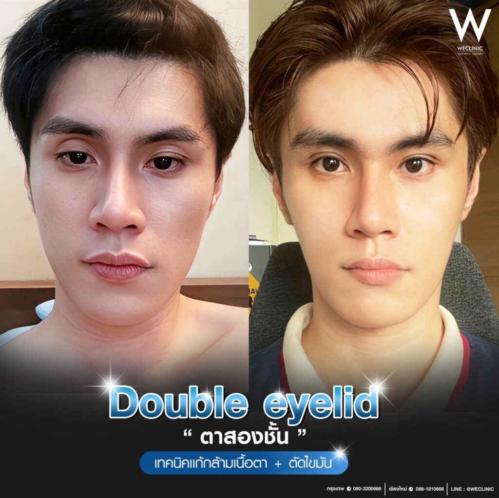 หนังตาตก มีลักษณะอย่างไร