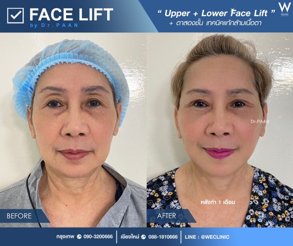 หนังตาตก มีวิธีการรักษาอย่างไร