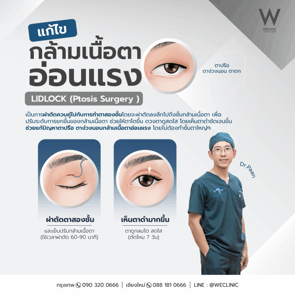 หนังตาตกจากกล้ามเนื้อตาอ่อนแรง