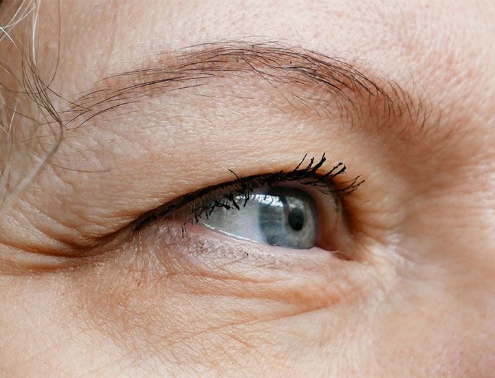 หนังตาตกในผู้สูงอายุ